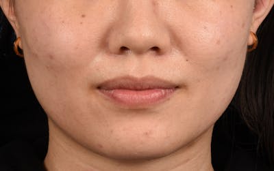 Thermage Flx Before & After Gallery - Patient 353955 - Image 1