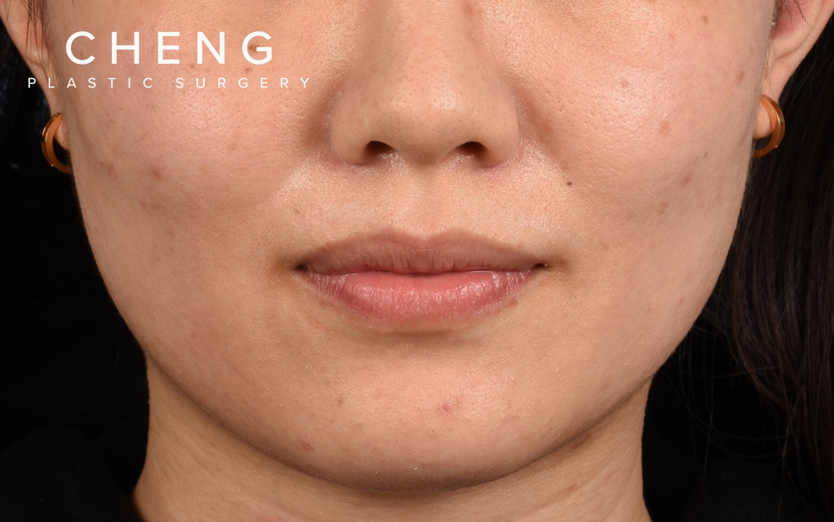 Hidden Patients Before & After Gallery - Patient 349943 - Image 1