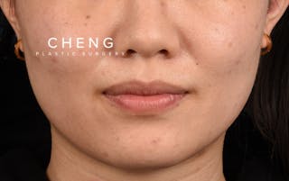 Hidden Patients Before & After Gallery - Patient 349943 - Image 1