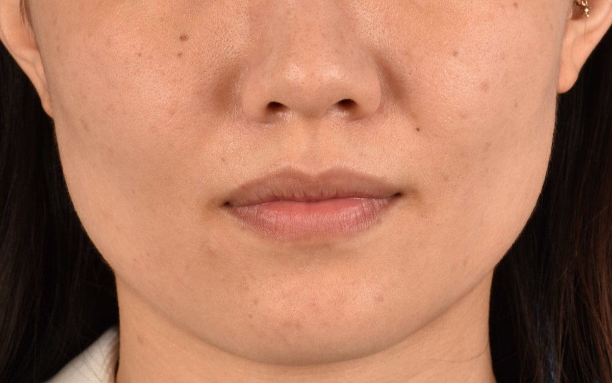 Thermage Flx Before & After Gallery - Patient 353955 - Image 2