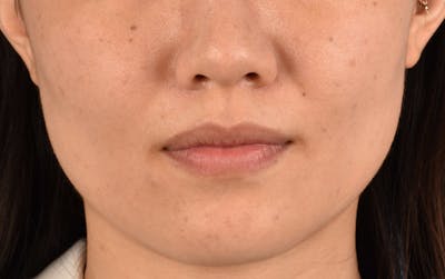 Thermage Flx Before & After Gallery - Patient 353955 - Image 2