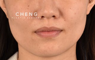 Hidden Patients Before & After Gallery - Patient 349943 - Image 2