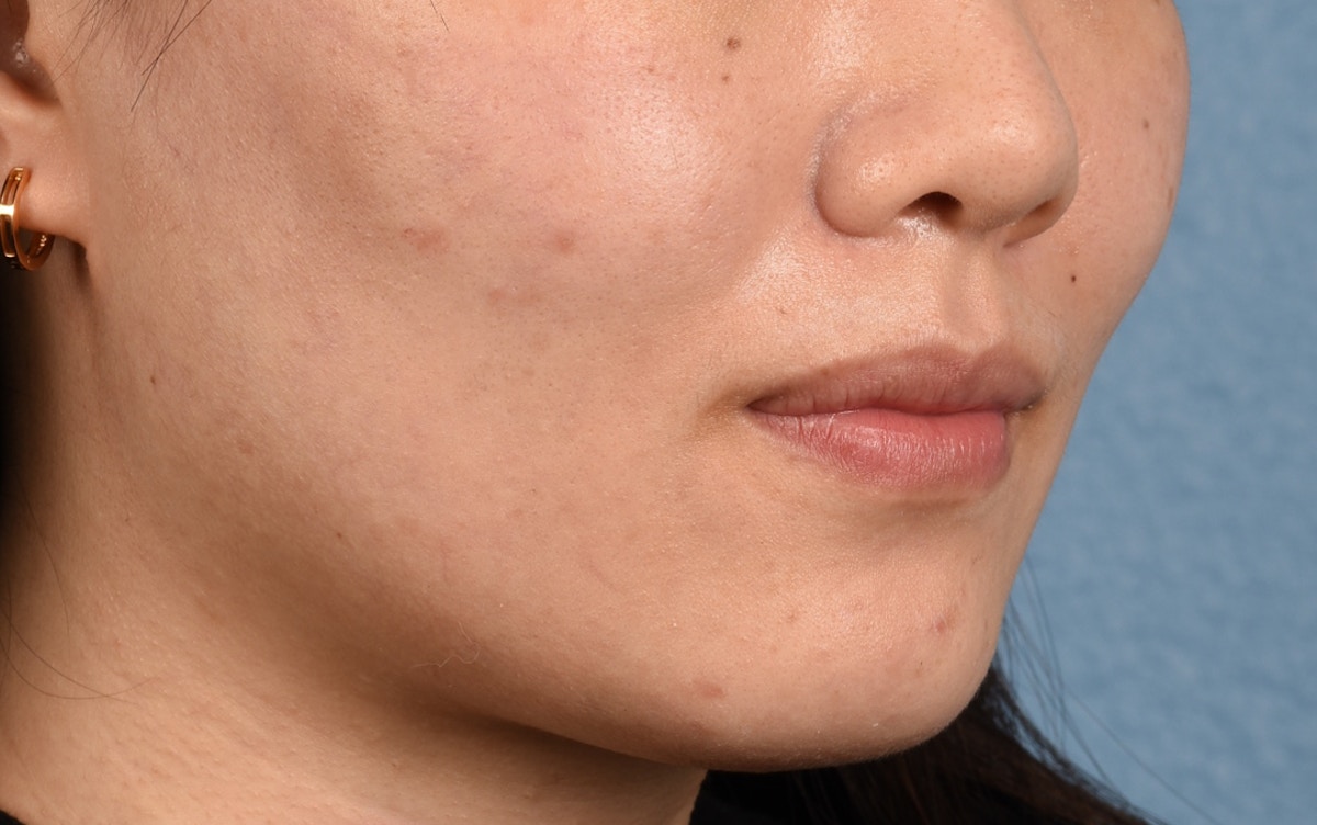 Thermage Flx Before & After Gallery - Patient 353955 - Image 3