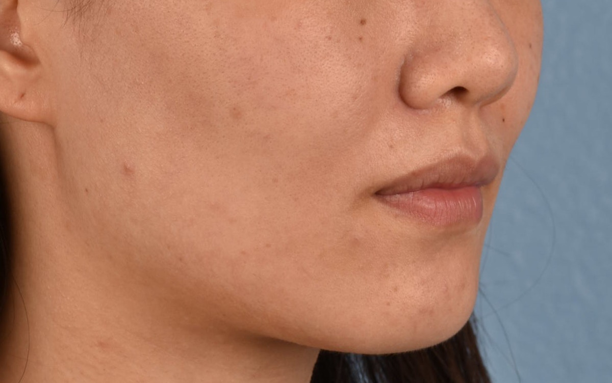 Thermage Flx Before & After Gallery - Patient 353955 - Image 4