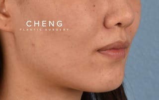 Hidden Patients Before & After Gallery - Patient 349943 - Image 4