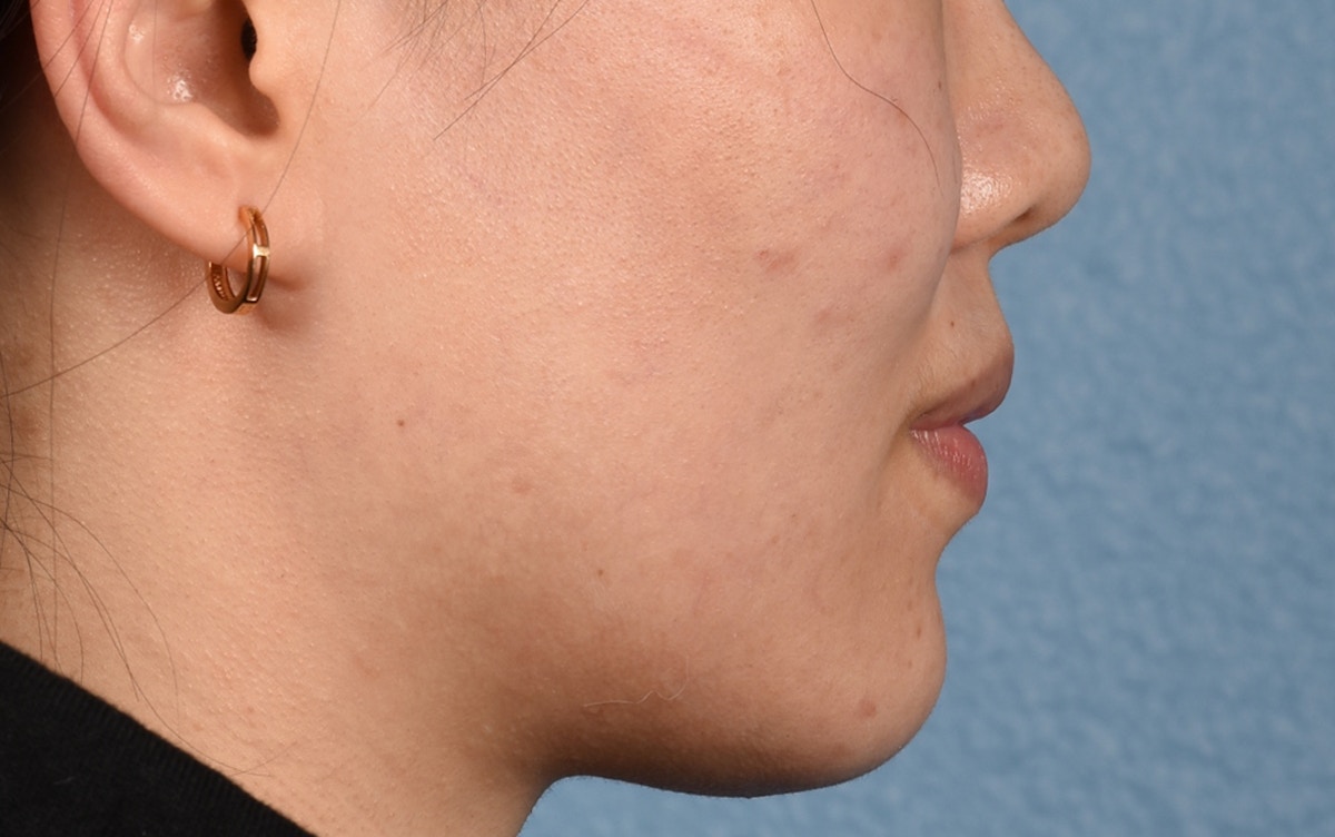 Thermage Flx Before & After Gallery - Patient 353955 - Image 5