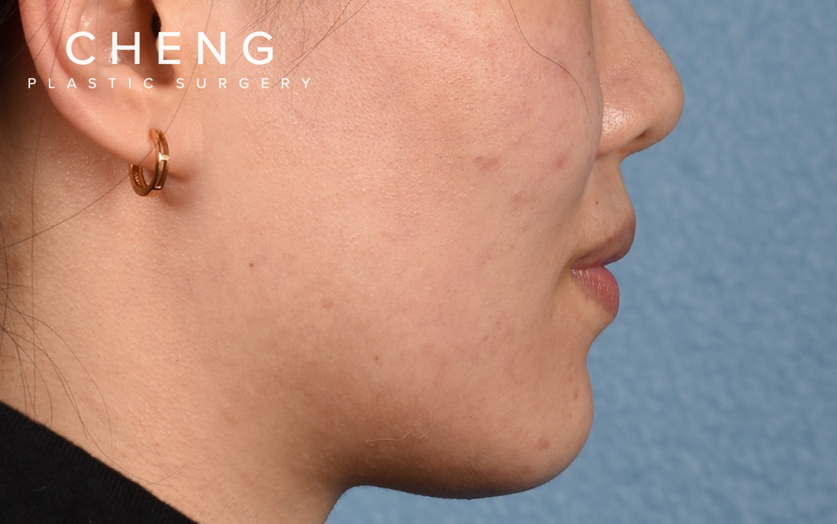 Hidden Patients Before & After Gallery - Patient 349943 - Image 5