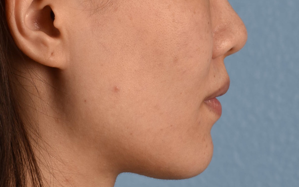 Thermage Flx Before & After Gallery - Patient 353955 - Image 6