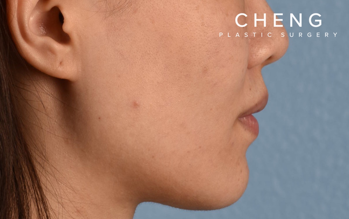 Hidden Patients Before & After Gallery - Patient 349943 - Image 6