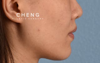 Hidden Patients Before & After Gallery - Patient 349943 - Image 6