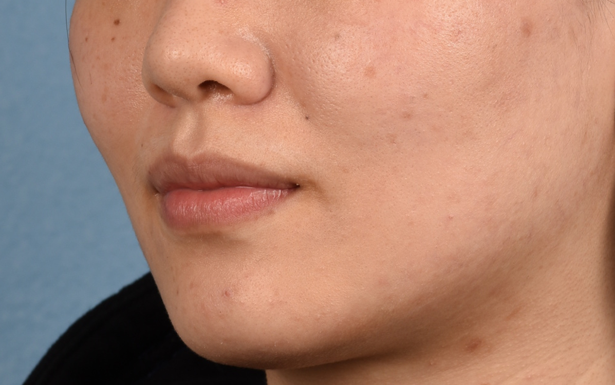 Hidden Patients Before & After Gallery - Patient 349943 - Image 7