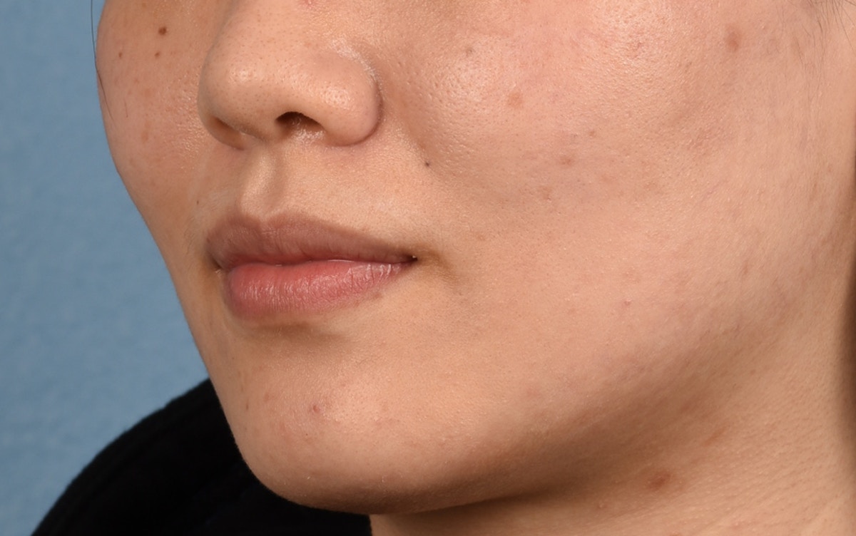 Thermage Flx Before & After Gallery - Patient 353955 - Image 7