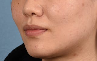 Hidden Patients Before & After Gallery - Patient 349943 - Image 7