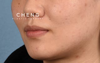 Hidden Patients Before & After Gallery - Patient 349943 - Image 7