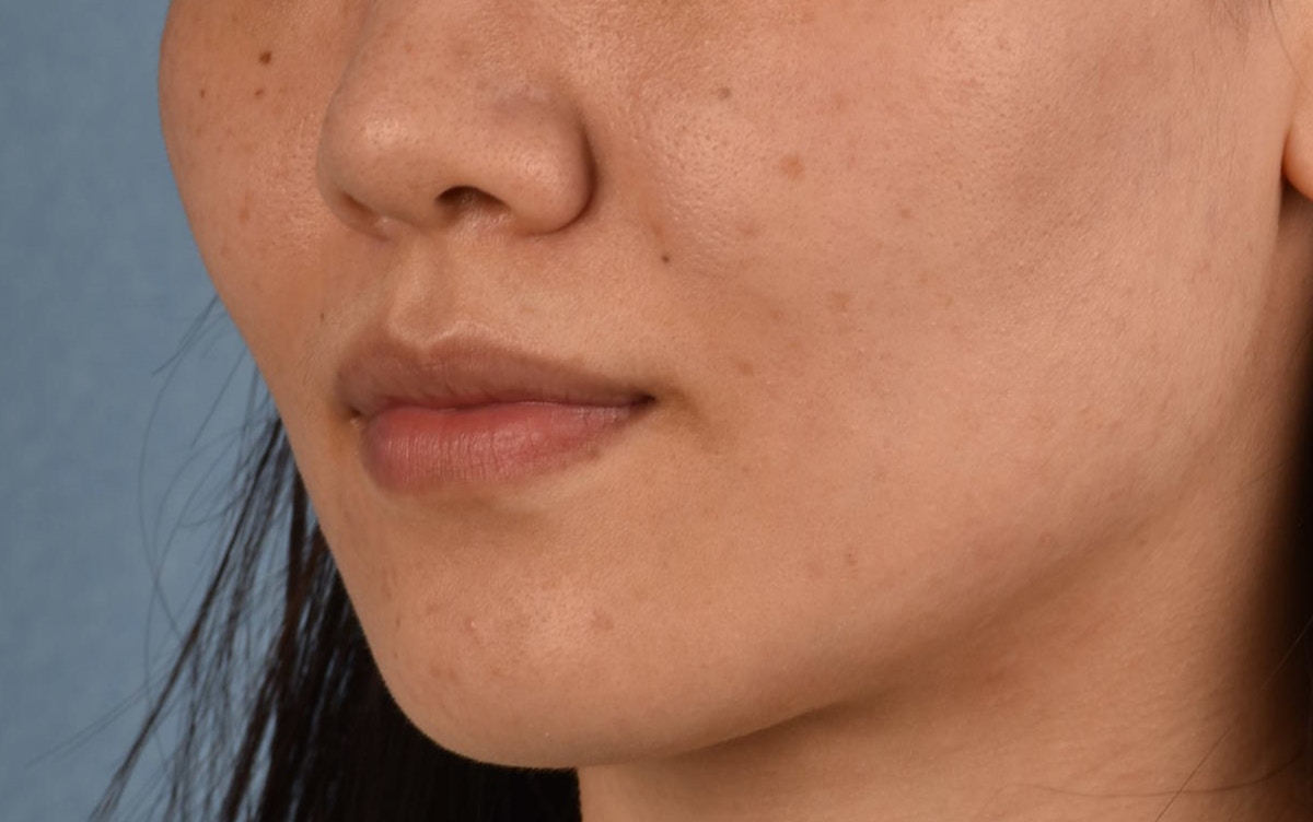 Thermage Flx Before & After Gallery - Patient 353955 - Image 8