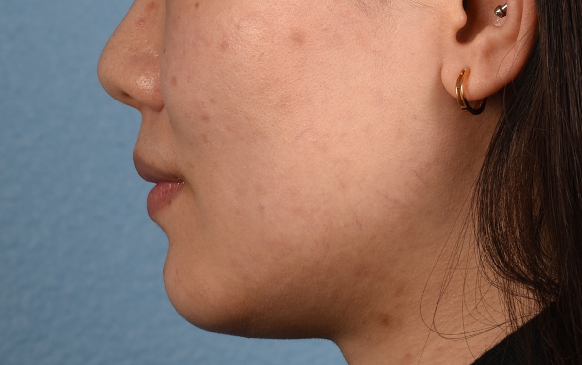 Thermage Flx Before & After Gallery - Patient 353955 - Image 9