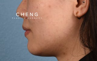 Hidden Patients Before & After Gallery - Patient 349943 - Image 9