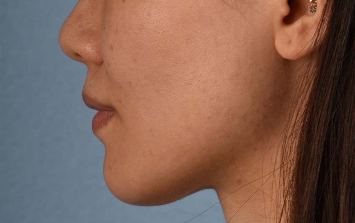 Thermage Flx Before & After Gallery - Patient 353955 - Image 10