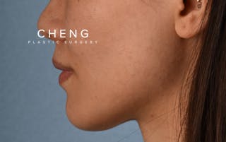 Hidden Patients Before & After Gallery - Patient 349943 - Image 10