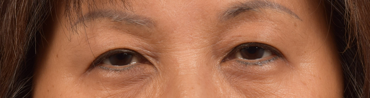 Hidden Patients Before & After Gallery - Patient 947245 - Image 1