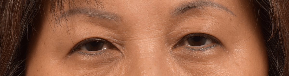 Thermage Flx Before & After Gallery - Patient 420609 - Image 1