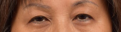 Thermage Flx Before & After Gallery - Patient 420609 - Image 1