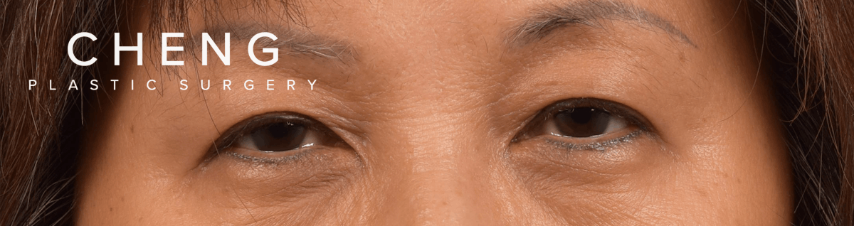 Hidden Patients Before & After Gallery - Patient 947245 - Image 1