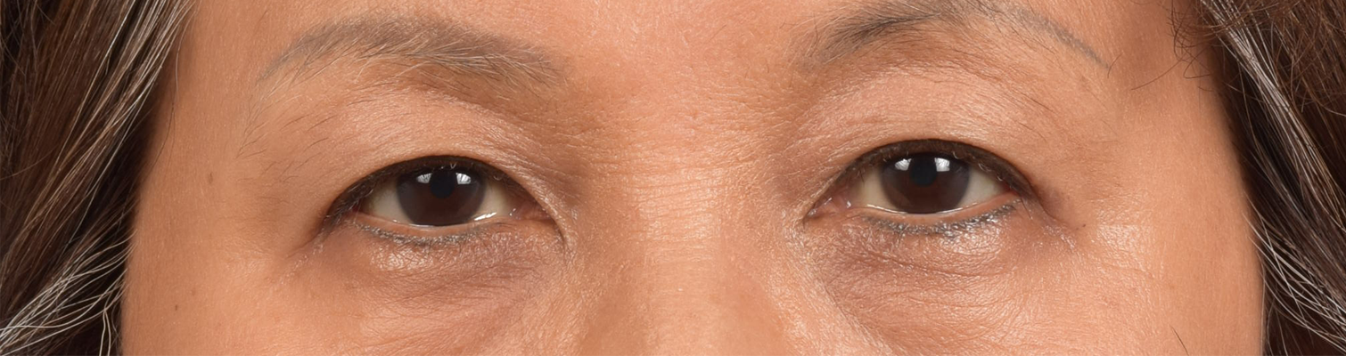 Hidden Patients Before & After Gallery - Patient 947245 - Image 2