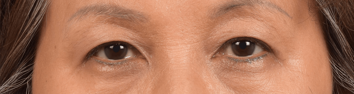 Thermage Flx Before & After Gallery - Patient 420609 - Image 2