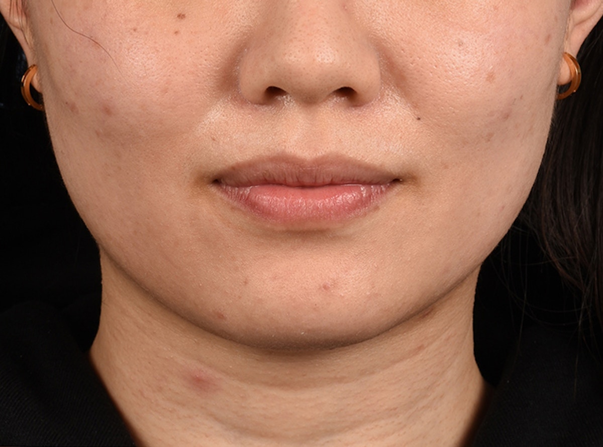 Thermage Flx Before & After Gallery - Patient 424510 - Image 1