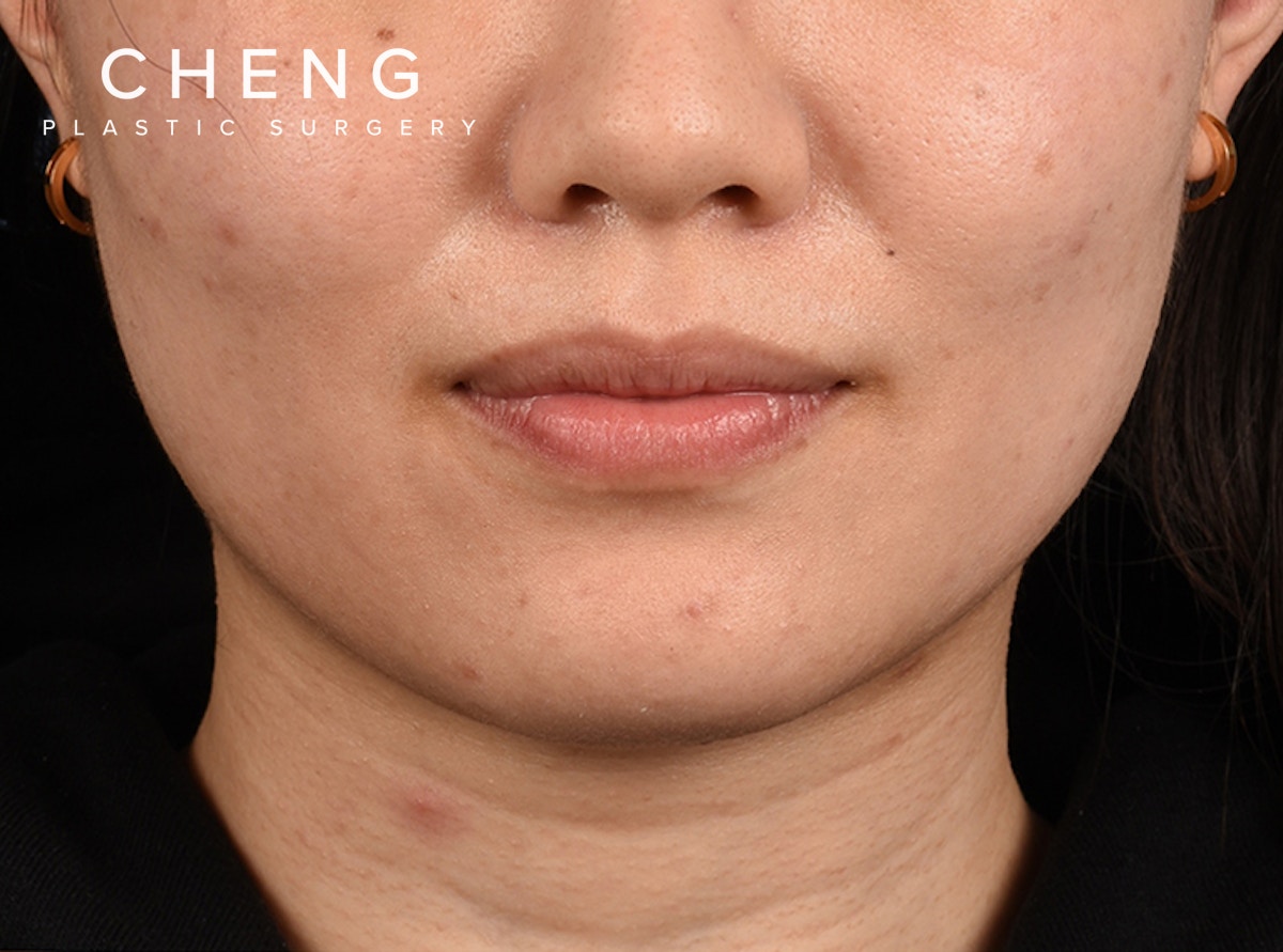 Hidden Patients Before & After Gallery - Patient 146208 - Image 1