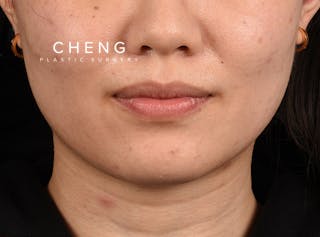 Hidden Patients Before & After Gallery - Patient 146208 - Image 1