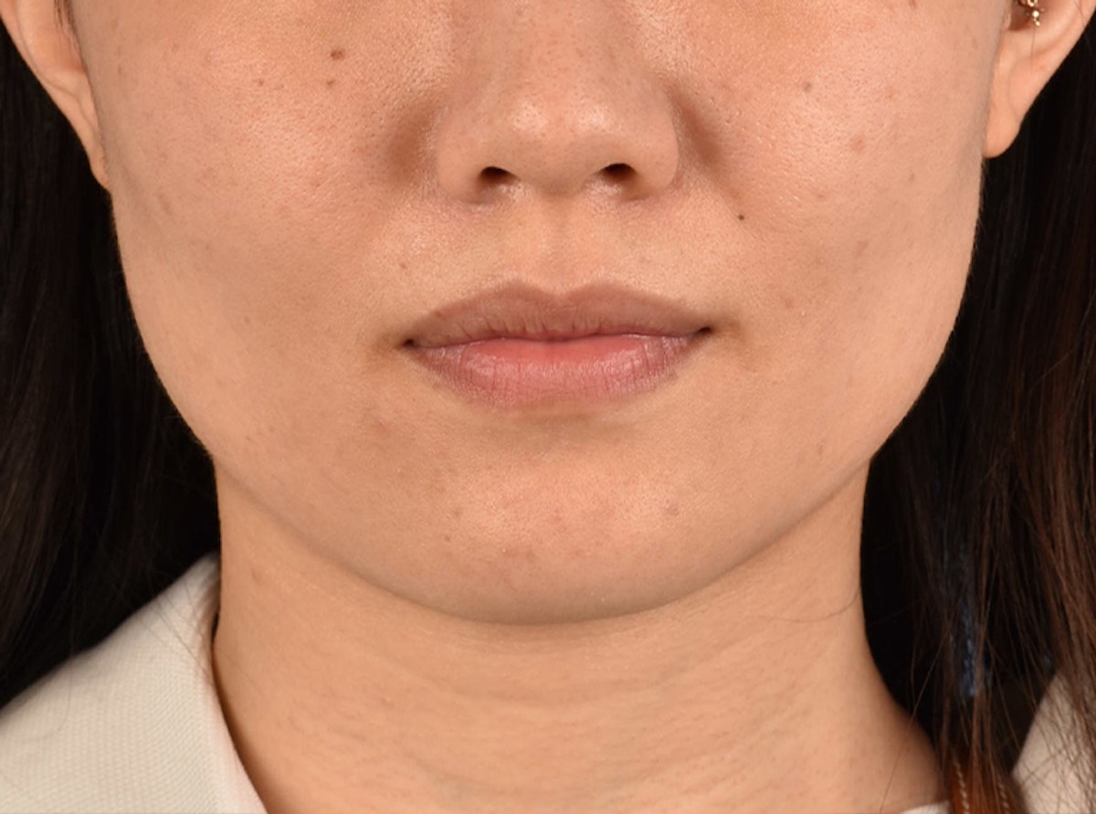 Thermage Flx Before & After Gallery - Patient 424510 - Image 2