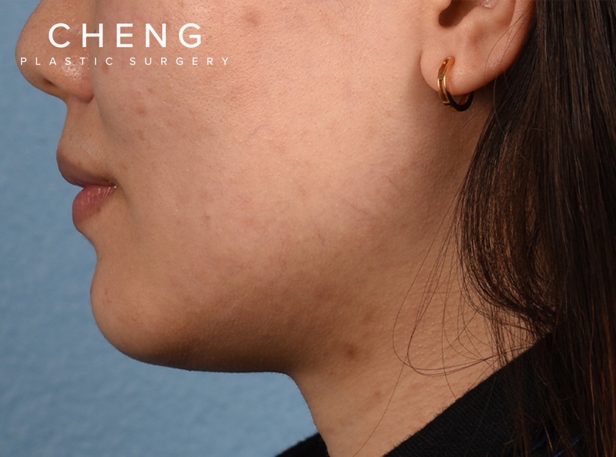 Hidden Patients Before & After Gallery - Patient 146208 - Image 3