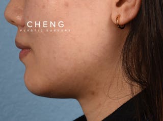 Hidden Patients Before & After Gallery - Patient 146208 - Image 3