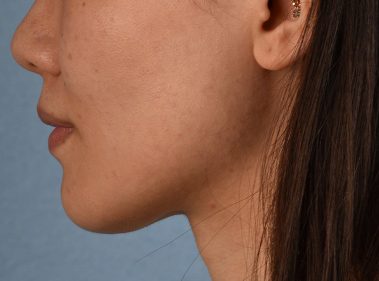 Hidden Patients Before & After Gallery - Patient 146208 - Image 4