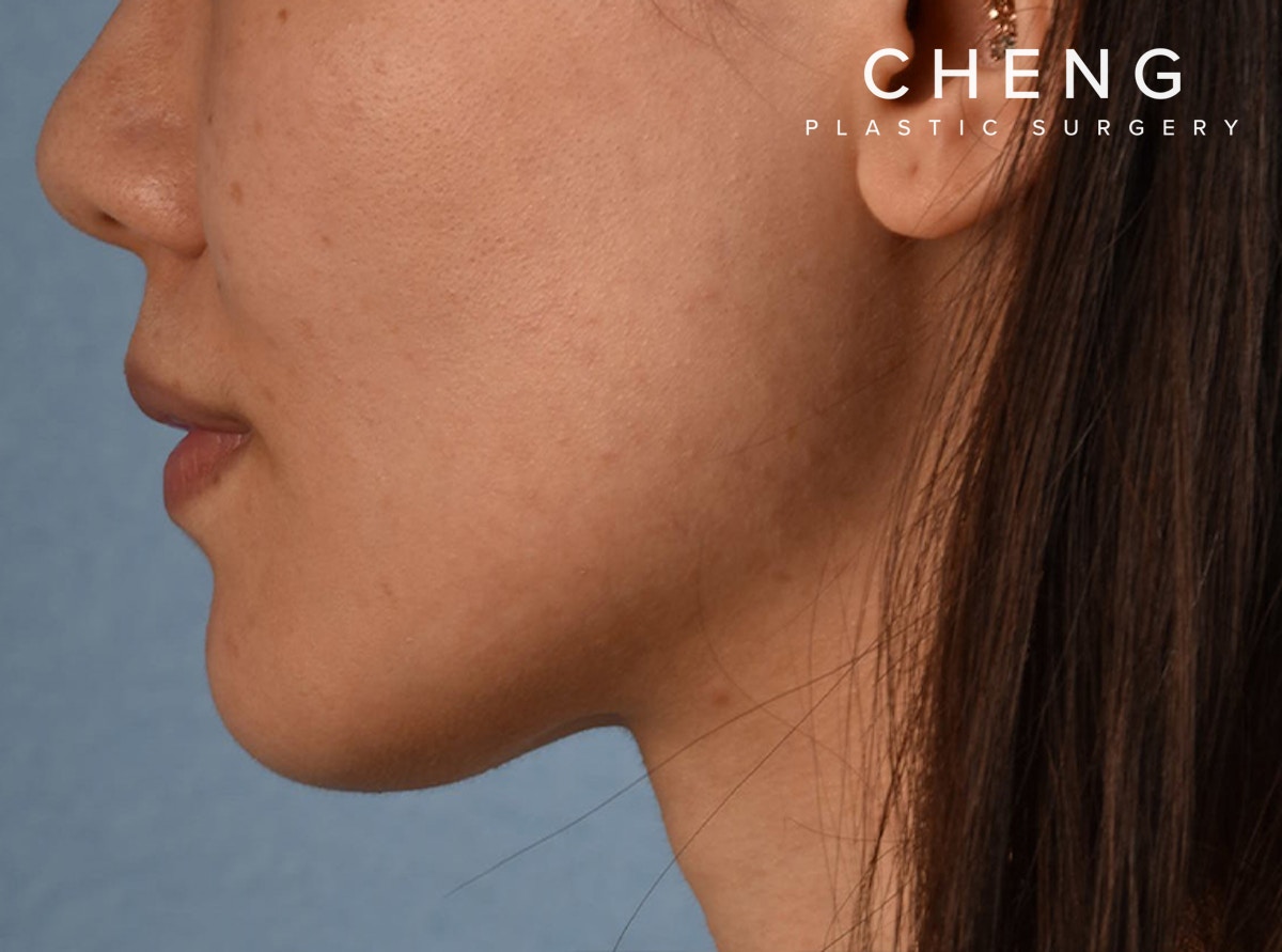 Hidden Patients Before & After Gallery - Patient 146208 - Image 4