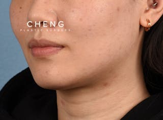 Hidden Patients Before & After Gallery - Patient 146208 - Image 5