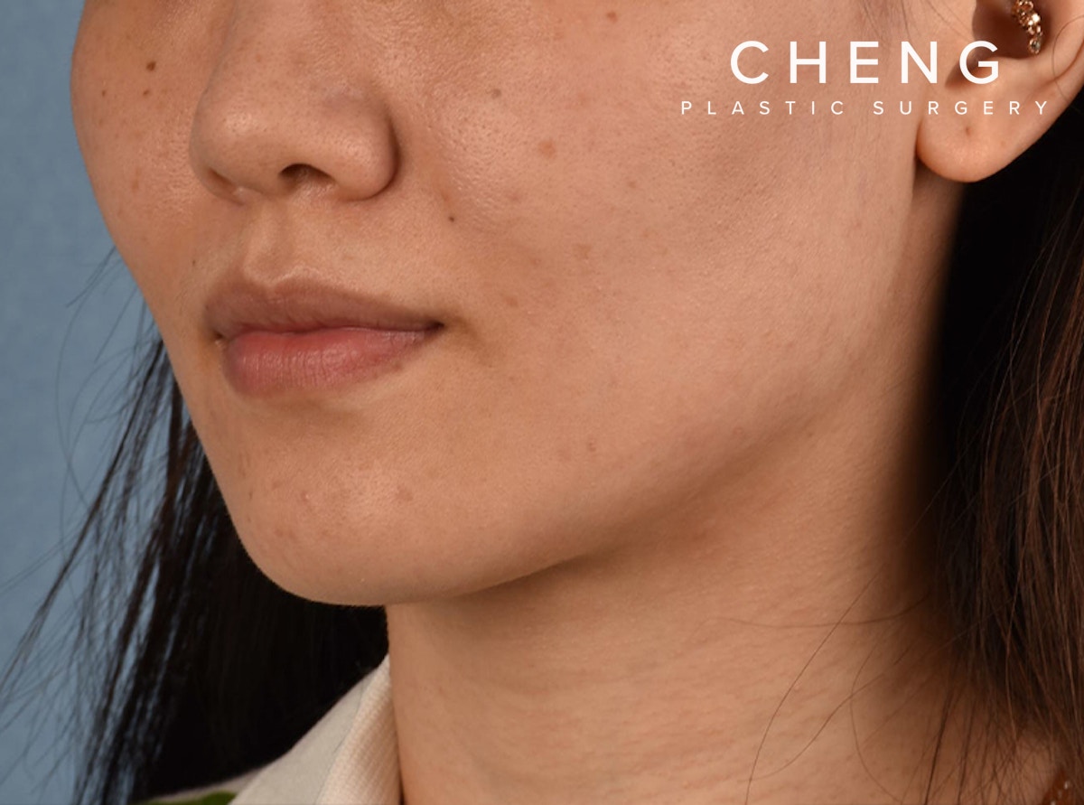 Hidden Patients Before & After Gallery - Patient 146208 - Image 6