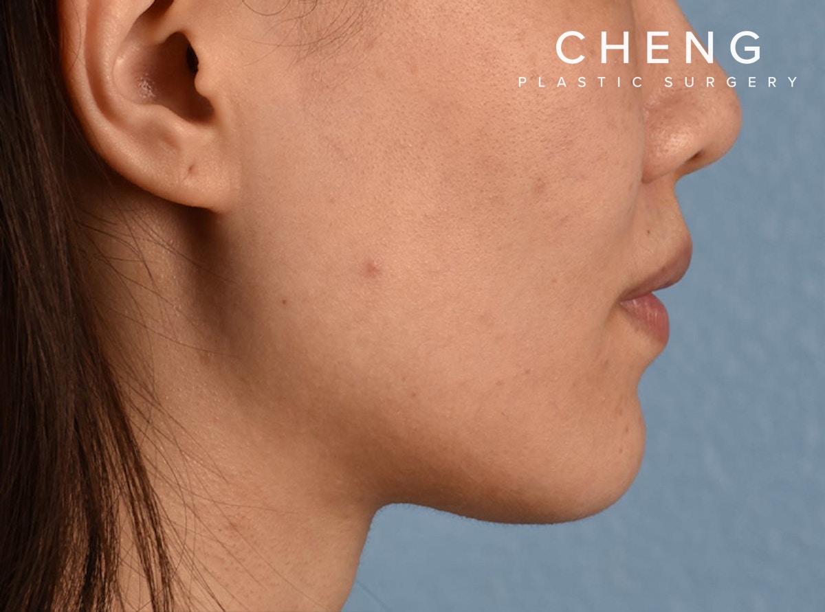 Hidden Patients Before & After Gallery - Patient 146208 - Image 8