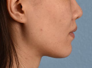 Hidden Patients Before & After Gallery - Patient 146208 - Image 8