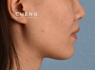 Hidden Patients Before & After Gallery - Patient 146208 - Image 8