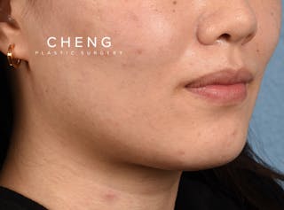 Hidden Patients Before & After Gallery - Patient 146208 - Image 9