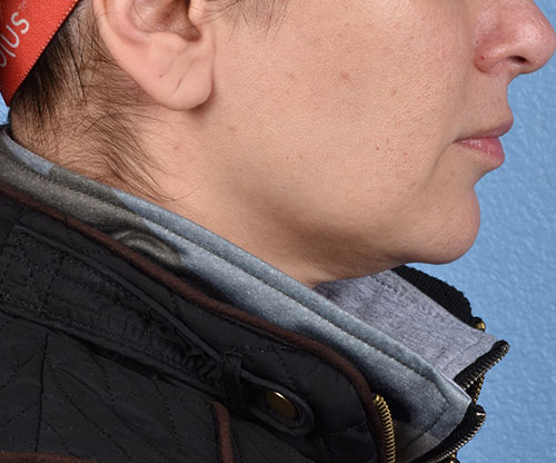 Thermage Flx Before & After Gallery - Patient 227424 - Image 1