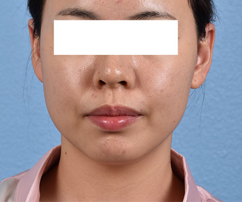 Thermage Flx Before & After Gallery - Patient 163377 - Image 1