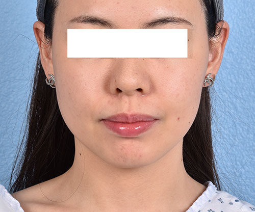 Thermage Flx Before & After Gallery - Patient 163377 - Image 2
