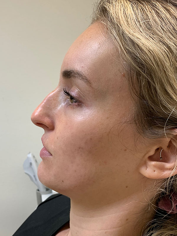 Non Surgical Rhinoplasty Before & After Gallery - Patient 177517 - Image 1