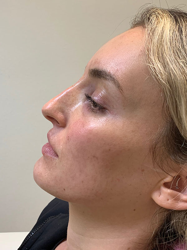 Non Surgical Rhinoplasty Before & After Gallery - Patient 177517 - Image 2