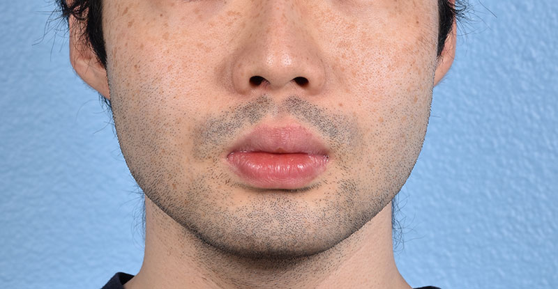 Skincare Before & After Gallery - Patient 330737 - Image 1