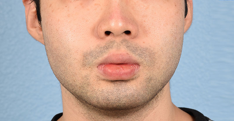 Skincare Before & After Gallery - Patient 330737 - Image 2